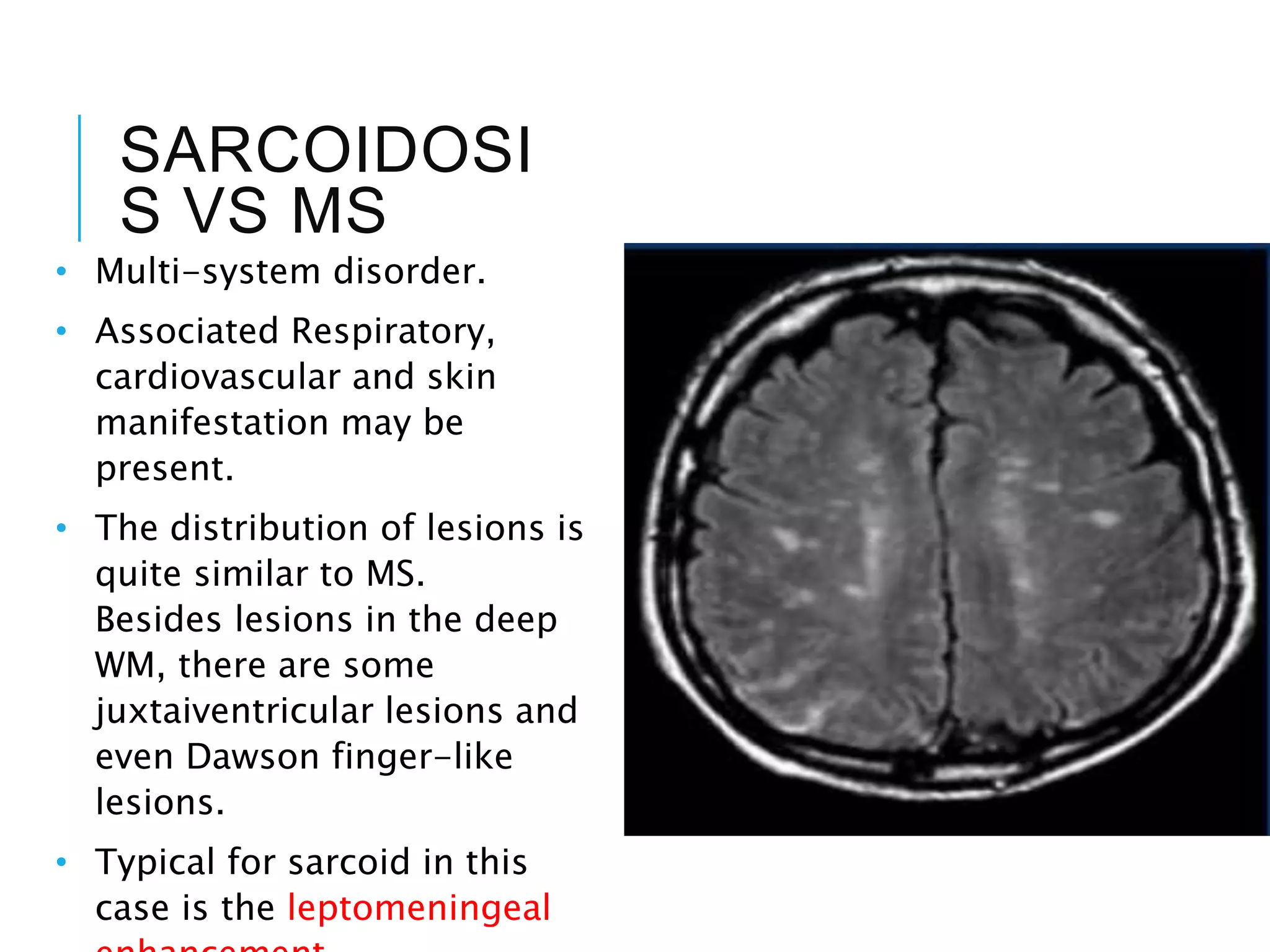 SARCOIDOSI
S VS MS
• Multi-system disorder.
• Associated Respiratory,
cardiovascular and skin
manifestation may be
present.
• The distribution of lesions is
quite similar to MS.
Besides lesions in the deep
WM, there are some
juxtaiventricular lesions and
even Dawson finger-like
lesions.
• Typical for sarcoid in this
case is the leptomeningeal
 
