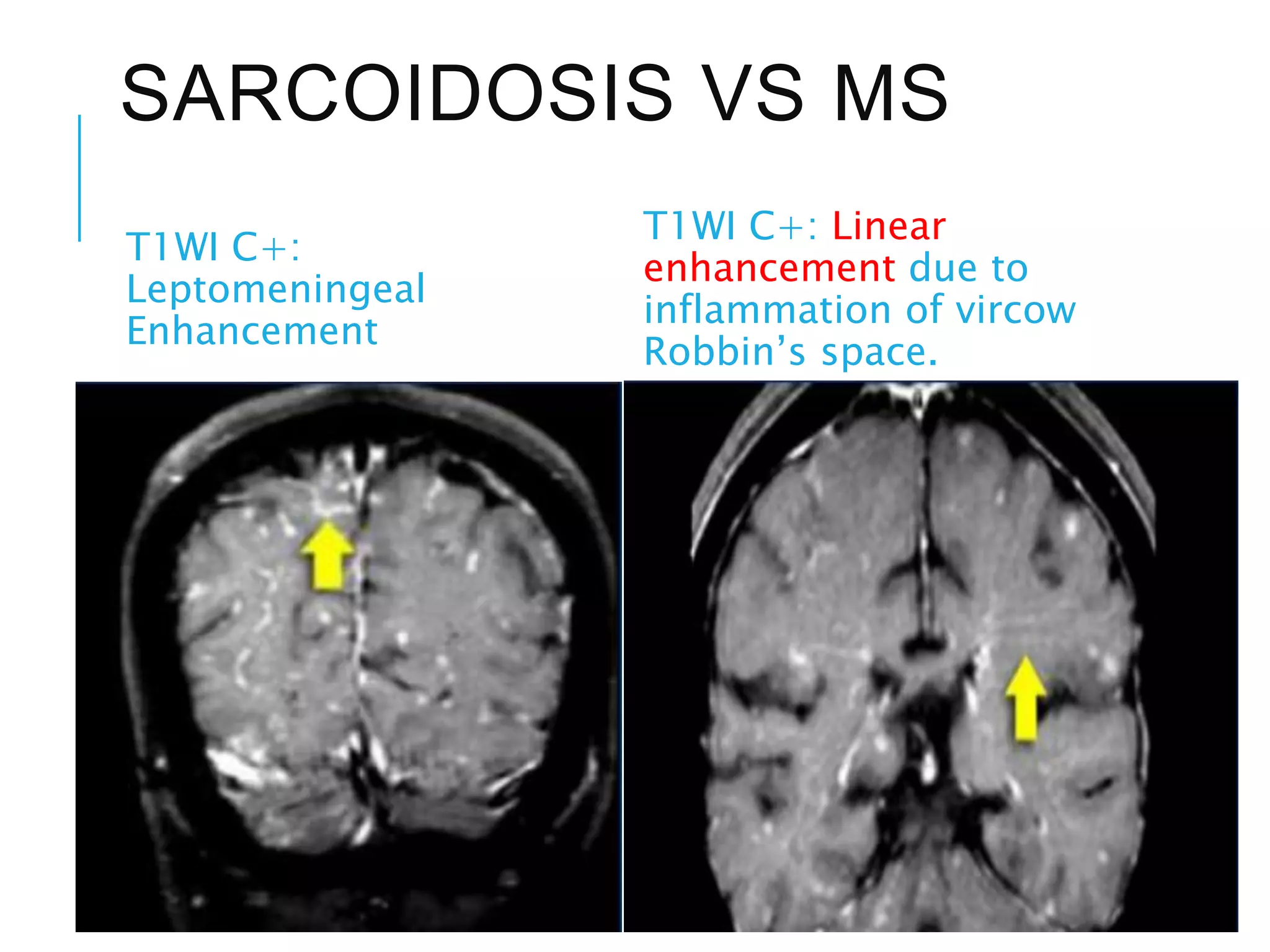 SARCOIDOSIS VS MS
T1WI C+:
Leptomeningeal
Enhancement
T1WI C+: Linear
enhancement due to
inflammation of vircow
Robbin’s space.
 