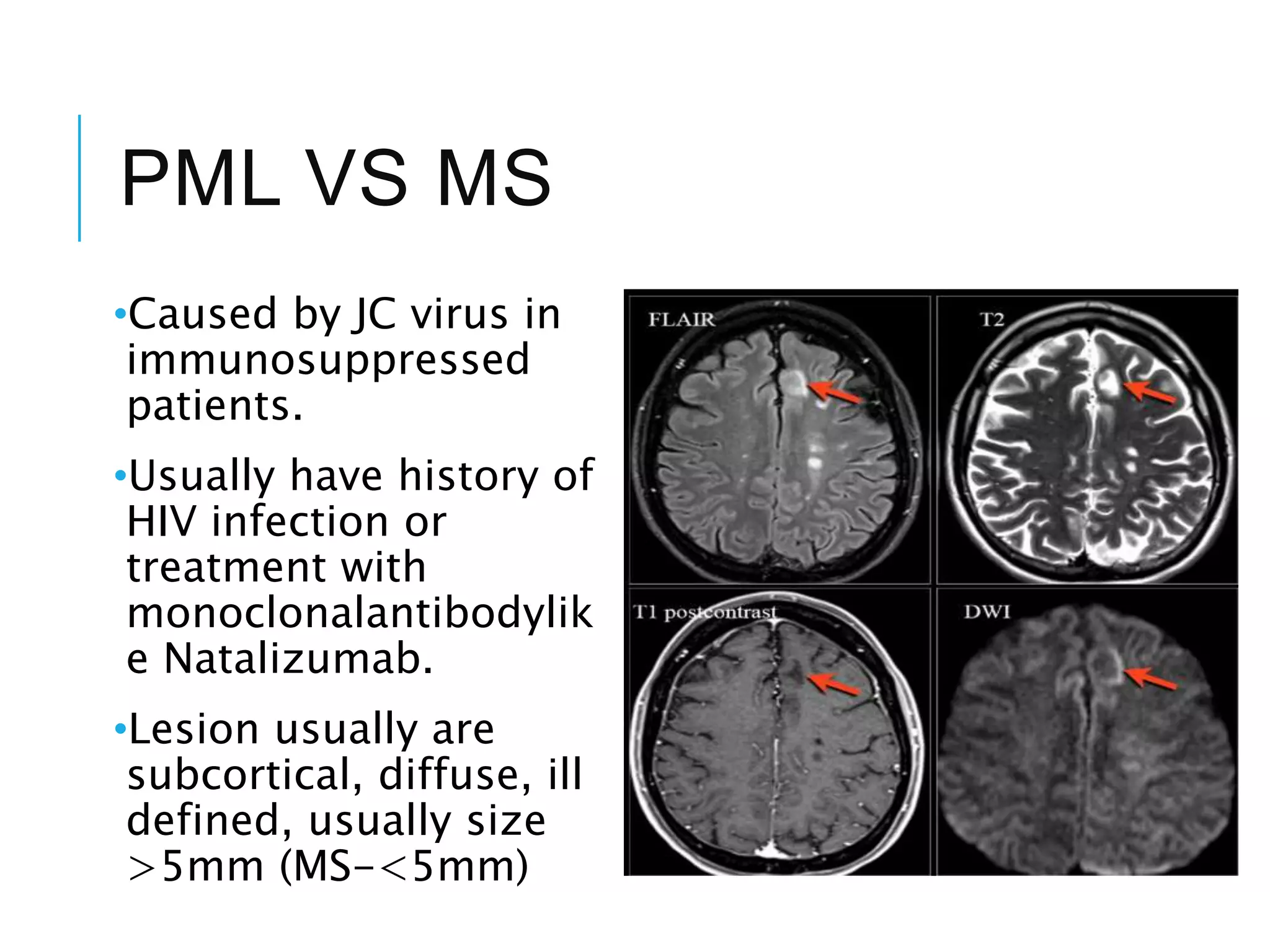 PML VS MS
•Caused by JC virus in
immunosuppressed
patients.
•Usually have history of
HIV infection or
treatment with
monoclonalantibodylik
e Natalizumab.
•Lesion usually are
subcortical, diffuse, ill
defined, usually size
>5mm (MS-<5mm)
 