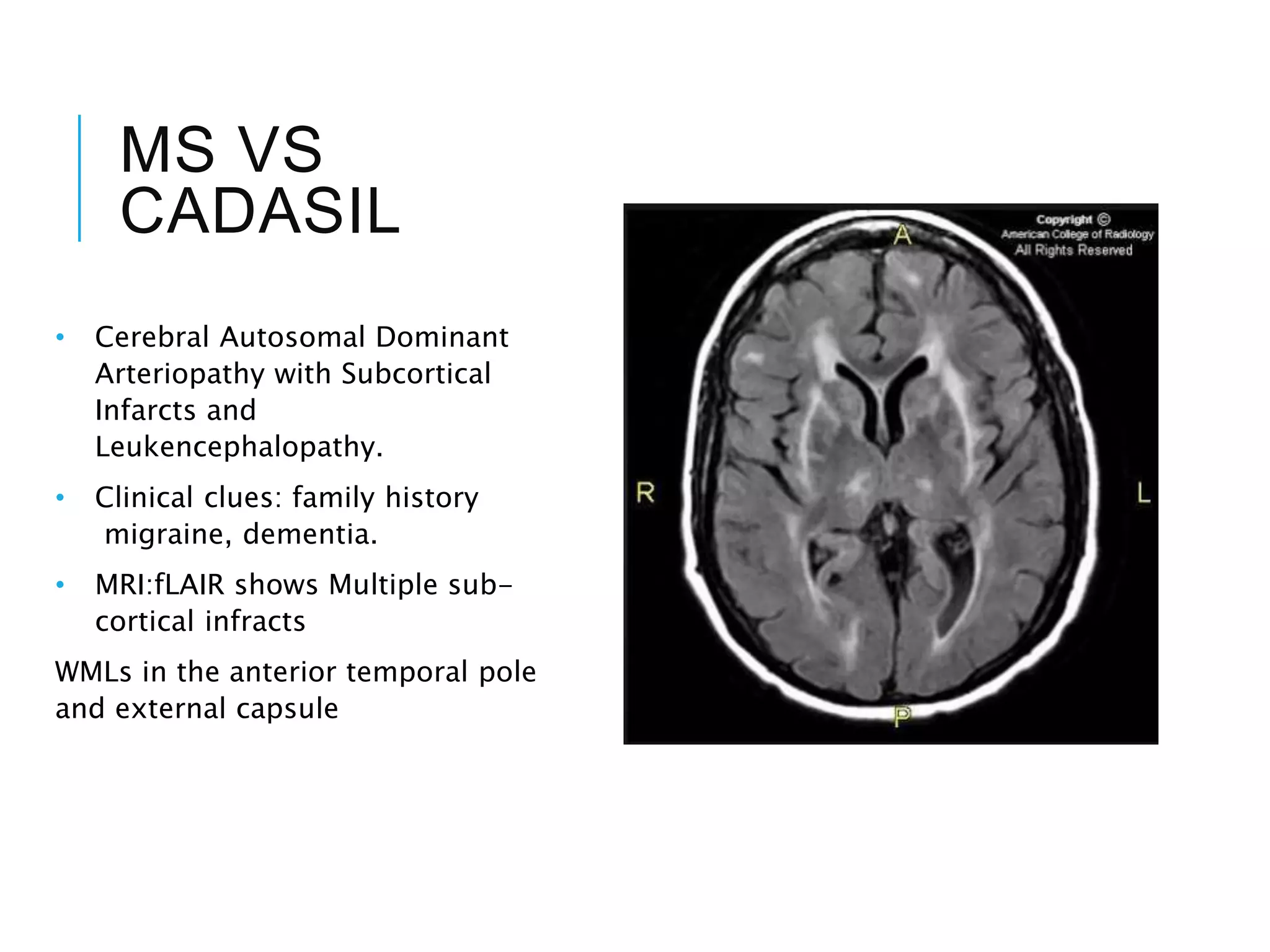 MS VS
CADASIL
• Cerebral Autosomal Dominant
Arteriopathy with Subcortical
Infarcts and
Leukencephalopathy.
• Clinical clues: family history
migraine, dementia.
• MRI:fLAIR shows Multiple sub-
cortical infracts
WMLs in the anterior temporal pole
and external capsule
 