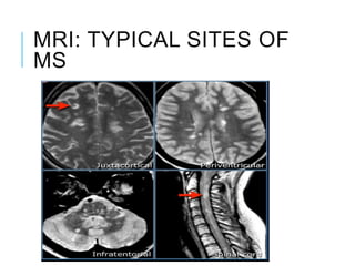 MRI: TYPICAL SITES OF
MS
 