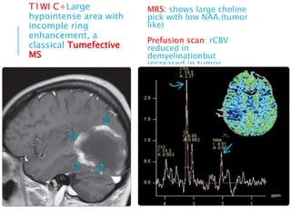 T1WI C+Large
hypointense area with
incomple ring
enhancement, a
classical Tumefective
MS
MRS: shows large choline
pick with low NAA.(tumor
like)
Prefusion scan: rCBV
reduced in
demyelinationbut
increased in tumor.
 