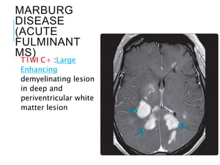 MARBURG
DISEASE
(ACUTE
FULMINANT
MS)
T1WI C+ :Large
Enhancing
demyelinating lesion
in deep and
periventricular white
matter lesion
 
