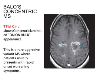 BALO’S
CONCENTRIC
MS
T1WI C+ :
showsConcentriclaminat
ed “ONION BULB”
appearance.
This is a rare aggresive
variant MS where
patients usually
presents with rapid
onset worsening
symptoms.
 