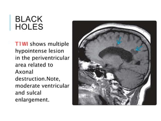 BLACK
HOLES
T1WI shows multiple
hypointense lesion
in the periventricular
area related to
Axonal
destruction.Note,
moderate ventricular
and sulcal
enlargement.
 