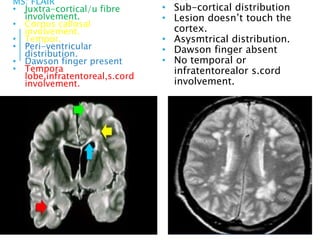 MS: FLAIR
• Juxtra-cortical/u fibre
involvement.
• Corpus callosal
involvement.
• Tempor.
• Peri-ventricular
distribution.
• Dawson finger present
• Tempora
lobe,infratentoreal,s.cord
involvement.
Vascular:T2 WI
• Sub-cortical distribution
• Lesion doesn’t touch the
cortex.
• Asysmtrical distribution.
• Dawson finger absent
• No temporal or
infratentorealor s.cord
involvement.
 