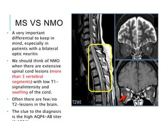 MS VS NMO
• A very important
differential to keep in
mind, especially in
patients with a bilateral
optic neuritis
• We should think of NMO
when there are extensive
spinal cord lesions (more
than 3 vertebral
segments) with low T1-
signalintensity and
swelling of the cord.
• Often there are few/no
T2-lesions in the brain.
• The clue to the diagnosis
is the high AQP4-AB titer
 