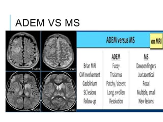 ADEM VS MS
 