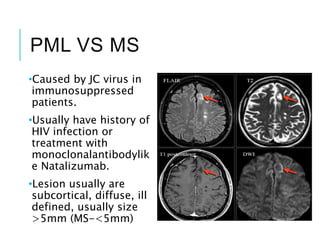 PML VS MS
•Caused by JC virus in
immunosuppressed
patients.
•Usually have history of
HIV infection or
treatment with
monoclonalantibodylik
e Natalizumab.
•Lesion usually are
subcortical, diffuse, ill
defined, usually size
>5mm (MS-<5mm)
 