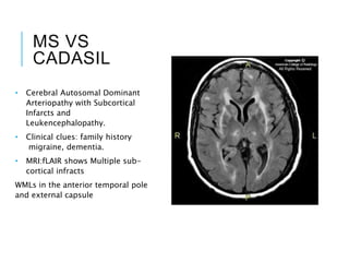 MS VS
CADASIL
• Cerebral Autosomal Dominant
Arteriopathy with Subcortical
Infarcts and
Leukencephalopathy.
• Clinical clues: family history
migraine, dementia.
• MRI:fLAIR shows Multiple sub-
cortical infracts
WMLs in the anterior temporal pole
and external capsule
 