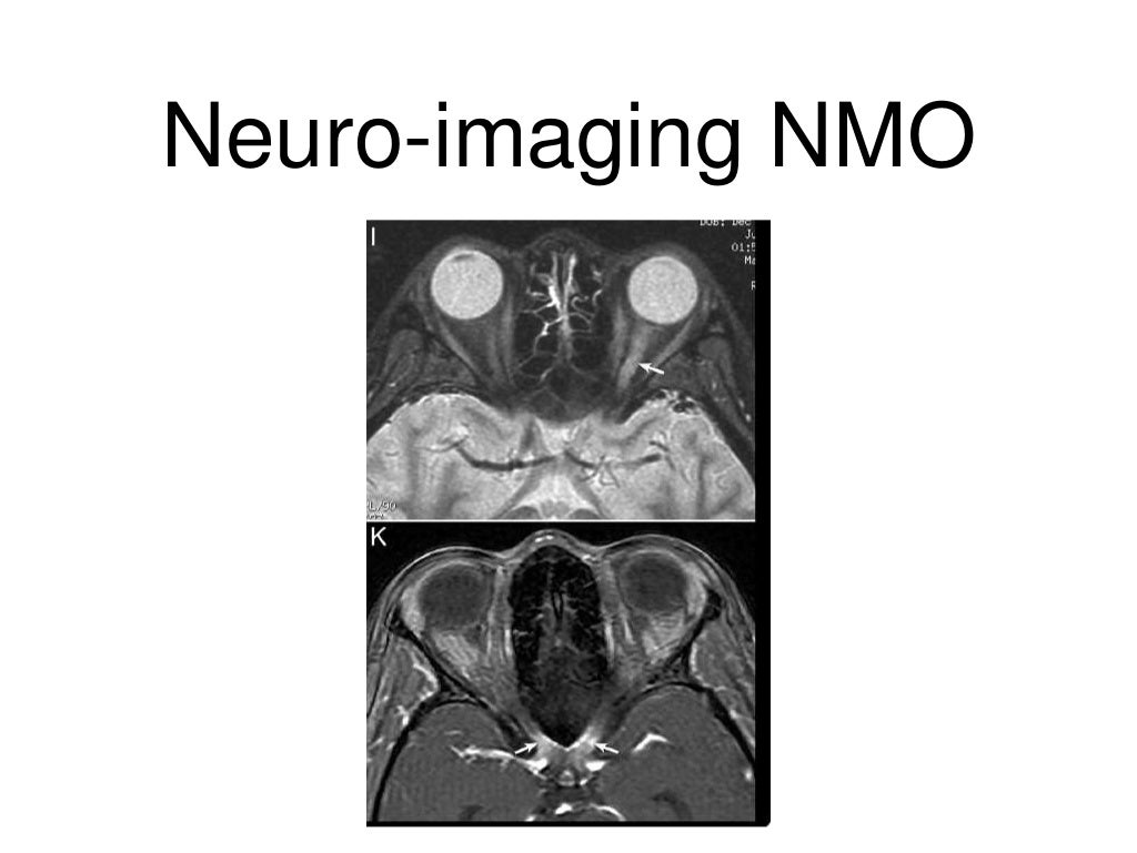 Optic Neuritis and OCT in Multiple Sclerosis