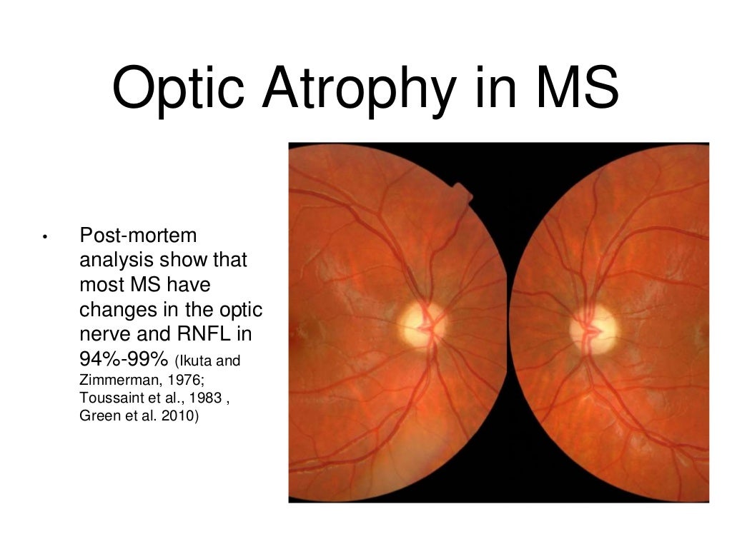 Optic Neuritis and OCT in Multiple Sclerosis