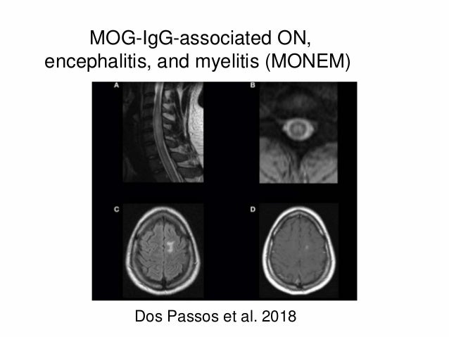 mog optic neuritis mog optic neuritis