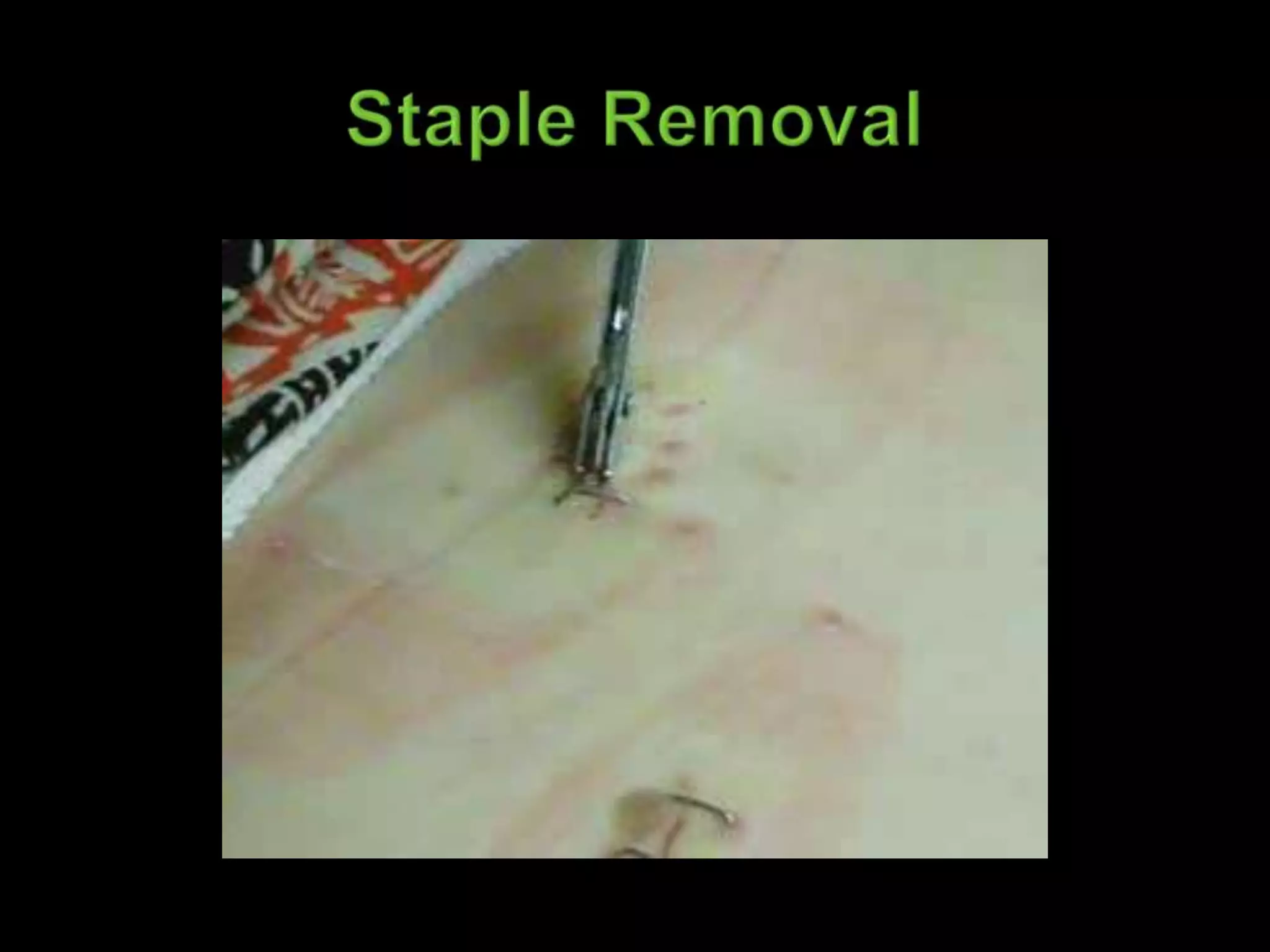 Staple Removal