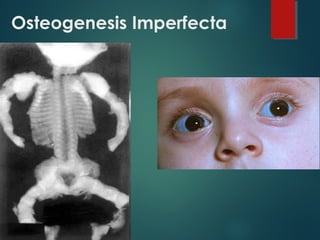 Osteogenesis Imperfecta
 