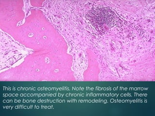 This is chronic osteomyelitis. Note the fibrosis of the marrow
space accompanied by chronic inflammatory cells. There
can be bone destruction with remodeling. Osteomyelitis is
very difficult to treat.
 