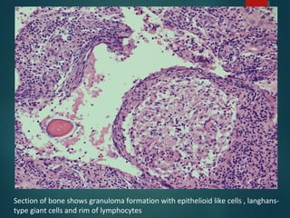 Section of bone shows granuloma formation with epithelioid like cells , langhans-
type giant cells and rim of lymphocytes
 