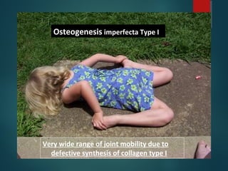 Osteogenesis imperfecta Type I
Very wide range of joint mobility due to
defective synthesis of collagen type I
 