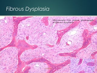 Fibrous Dysplasia
 
