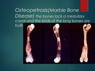 Osteopetrosis(Marble Bone
Disease) the bones lack a medullary
canal and the ends of the long bones are
bulbous and misshapen
 
