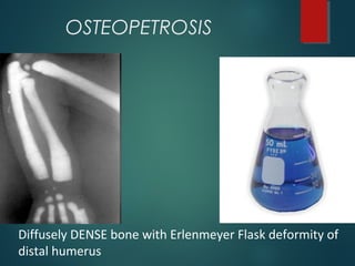 OSTEOPETROSIS
Diffusely DENSE bone with Erlenmeyer Flask deformity of
distal humerus
 