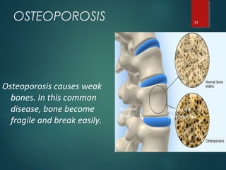 OSTEOPOROSIS 31
Bone with
Osteoporosis
Normal
Bone
Osteoporosis causes weak
bones. In this common
disease, bone become
fragile and break easily.
 