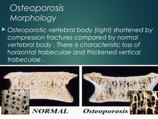 Osteoporosis
Morphology
 Osteoporotic vertebral body (right) shortened by
compression fractures compared by normal
vertebral body . There is characteristic loss of
horizontal trabeculae and thickened vertical
trabeculae .
 