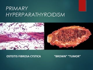 PRIMARY
HYPERPARATHYROIDISM
OSTEITIS FIBROSA CYSTICA “BROWN” “TUMOR”
 