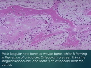 This is irregular new bone, or woven bone, which is forming
in the region of a fracture. Osteoblasts are seen lining the
irregular trabeculae, and there is an osteoclast near the
center.
 