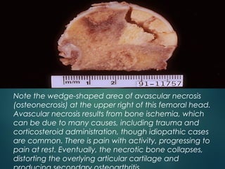 Note the wedge-shaped area of avascular necrosis
(osteonecrosis) at the upper right of this femoral head.
Avascular necrosis results from bone ischemia, which
can be due to many causes, including trauma and
corticosteroid administration, though idiopathic cases
are common. There is pain with activity, progressing to
pain at rest. Eventually, the necrotic bone collapses,
distorting the overlying articular cartilage and
 