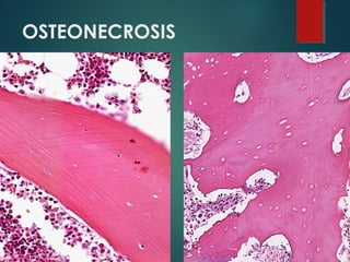 OSTEONECROSIS
 