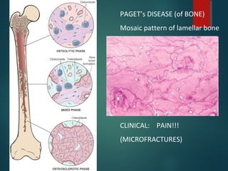 PAGET’s DISEASE (of BONE)
Mosaic pattern of lamellar bone
CLINICAL: PAIN!!!
(MICROFRACTURES)
 