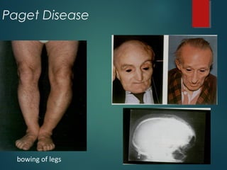 Paget Disease
bowing of legs
 