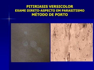 PITIRIASIS VERSICOLOR
EXAME DIRETO-ASPECTO EM PARASITISMO
        MÉTODO DE PORTO
 