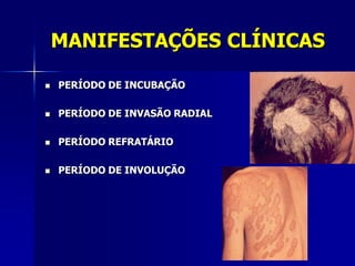 MANIFESTAÇÕES CLÍNICAS

   PERÍODO DE INCUBAÇÃO

   PERÍODO DE INVASÃO RADIAL

   PERÍODO REFRATÁRIO

   PERÍODO DE INVOLUÇÃO
 