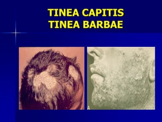 TINEA CAPITIS
TINEA BARBAE
 