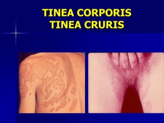 TINEA CORPORIS
 TINEA CRURIS
 