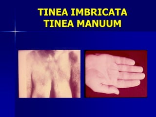 TINEA IMBRICATA
 TINEA MANUUM
 