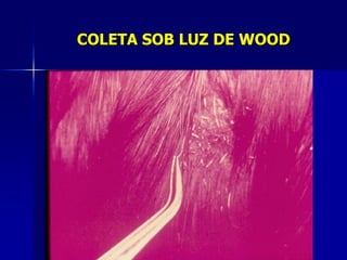 COLETA SOB LUZ DE WOOD
 