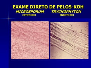EXAME DIRETO DE PELOS-KOH
MICROSPORUM    TRYCHOPHYTON
   ECTOTHRIX      ENDOTHRIX
 
