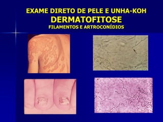 EXAME DIRETO DE PELE E UNHA-KOH
      DERMATOFITOSE
     FILAMENTOS E ARTROCONÍDIOS
 