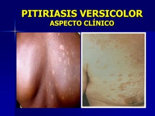 PITIRIASIS VERSICOLOR
    ASPECTO CLÍNICO
 