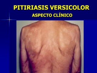 PITIRIASIS VERSICOLOR
     ASPECTO CLÍNICO
 