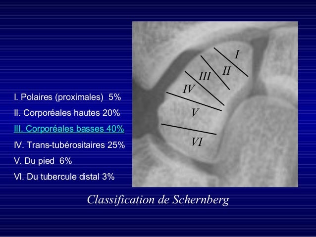 Msup Fractures Msup Fractures