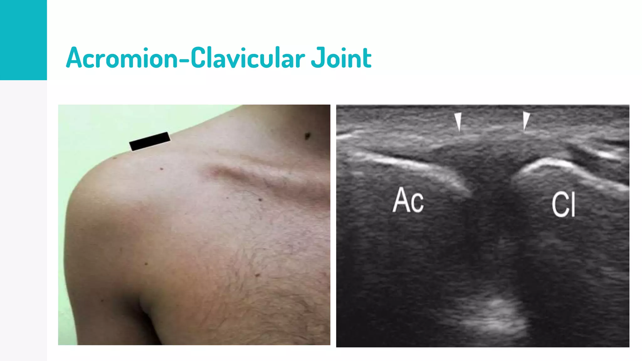 Muscloskeletal Ultrasound of the shoulder (basic level) | PPTX