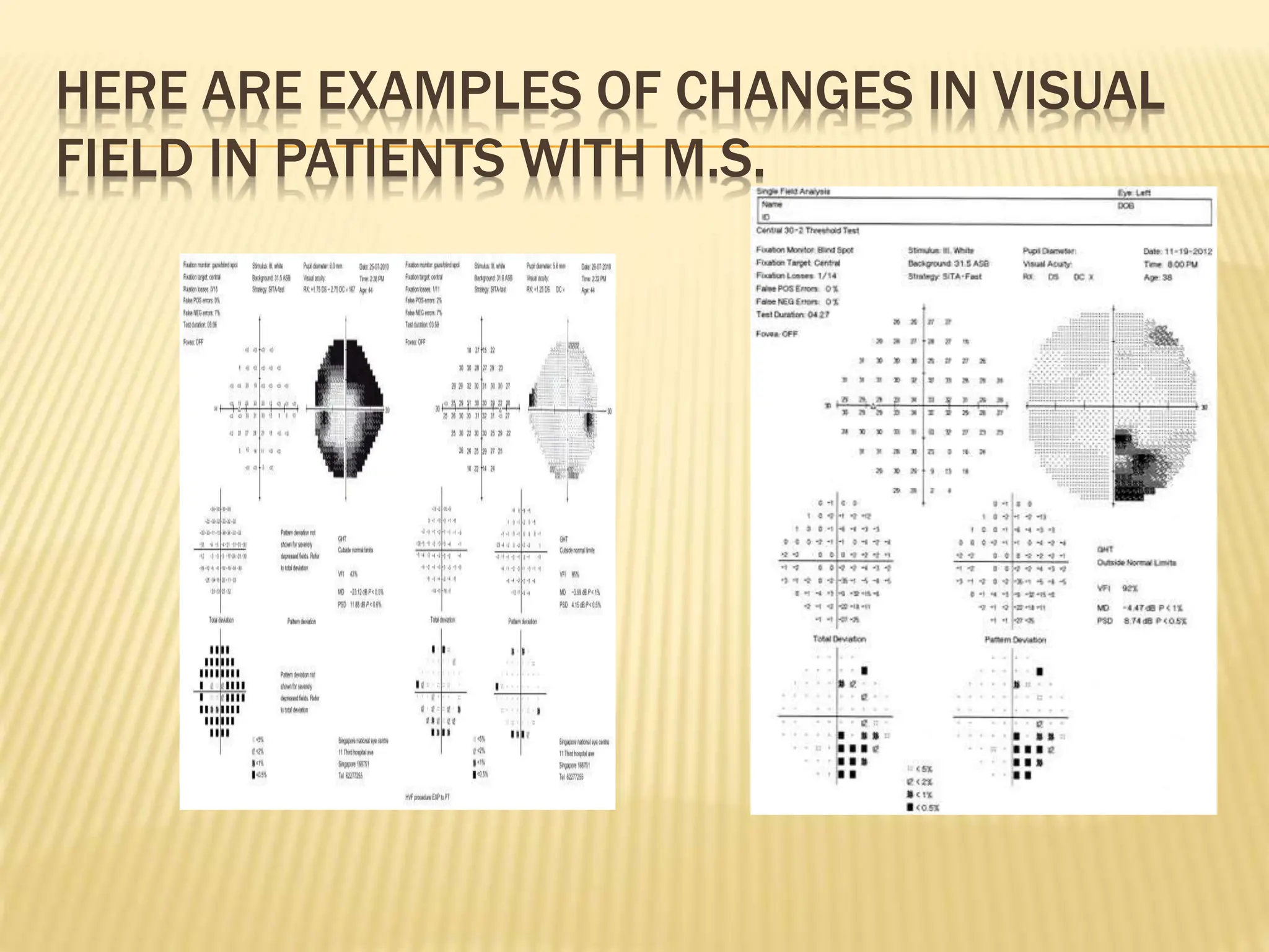 HERE ARE EXAMPLES OF CHANGES IN VISUAL
FIELD IN PATIENTS WITH M.S.
 