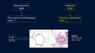 Архаг бронхит
УАБӨ
Эмфизем
УАБӨ
Том гуурсан хоолойнуудад
VEGF ↑ ↑
Уушгины паренхимд
VEGF ↓↓
IL-1β
TGF-β
BENEFIT:
Anti-TGF-β AB
ARB - TGF-β
 