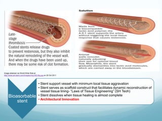 MT5007: The coronary stent revolution (A group project for the ...