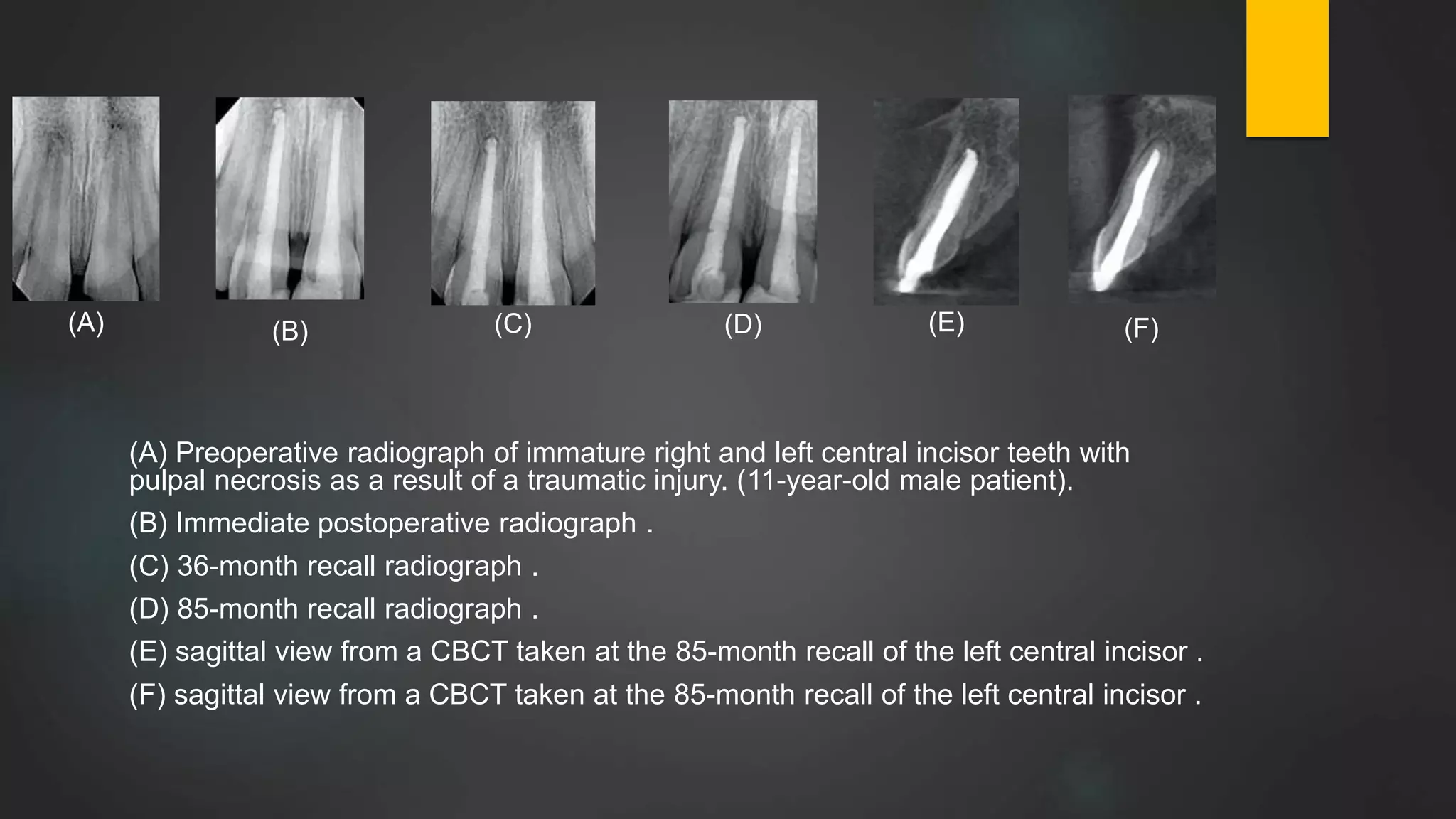 (A) Preoperative radiograph of immature right and left central incisor teeth with
pulpal necrosis as a result of a traumatic injury. (11-year-old male patient).
(B) Immediate postoperative radiograph .
(C) 36-month recall radiograph .
(D) 85-month recall radiograph .
(E) sagittal view from a CBCT taken at the 85-month recall of the left central incisor .
(F) sagittal view from a CBCT taken at the 85-month recall of the left central incisor .
(A) (B) (C) (D) (E) (F)
 