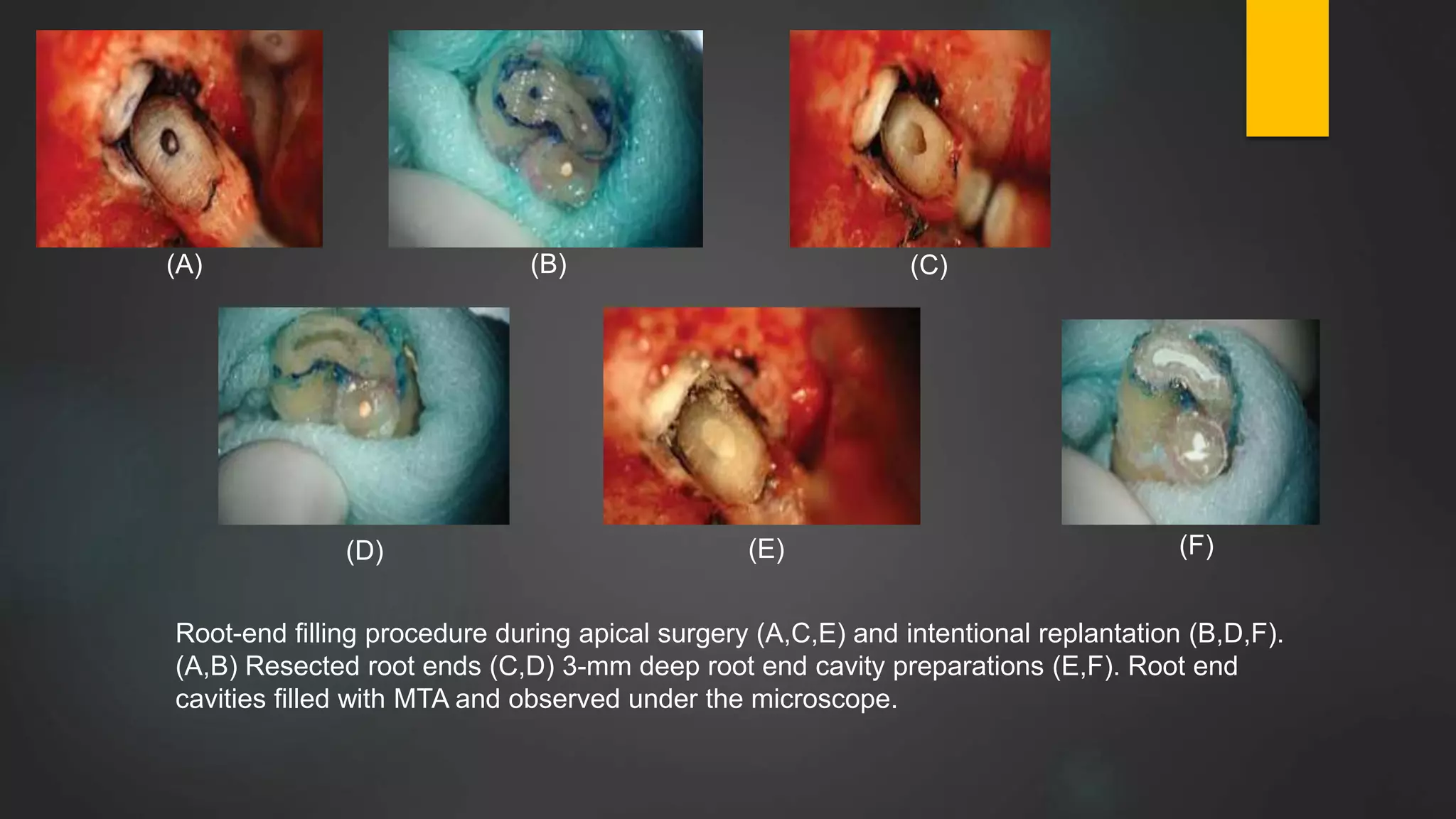(A) (B) (C)
(E) (F)(D)
Root-end filling procedure during apical surgery (A,C,E) and intentional replantation (B,D,F).
(A,B) Resected root ends (C,D) 3-mm deep root end cavity preparations (E,F). Root end
cavities filled with MTA and observed under the microscope.
 